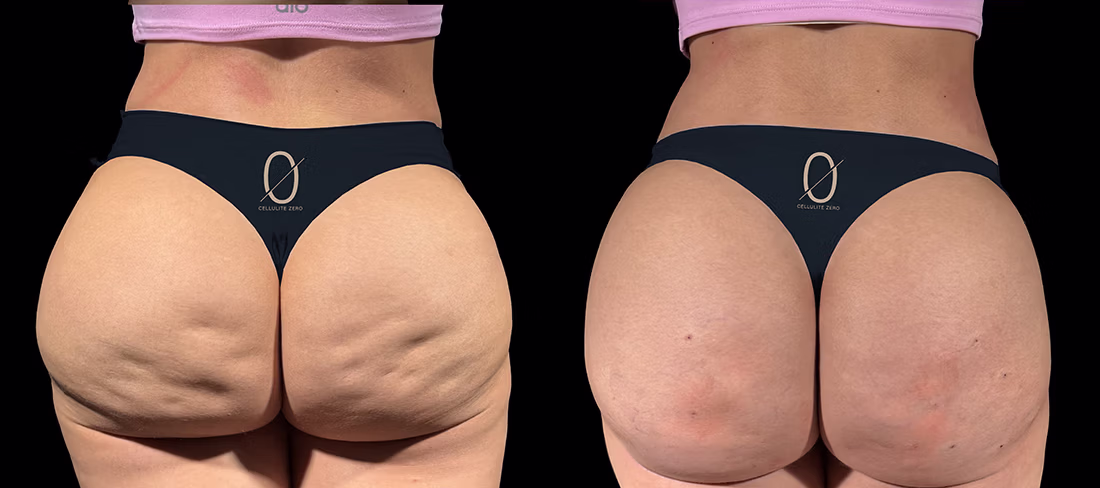 Fotografía real de paciente Cellulite ZERO