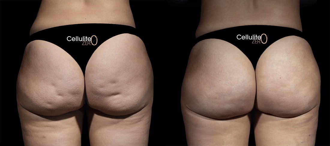 Fotografía real de paciente Cellulite ZERO