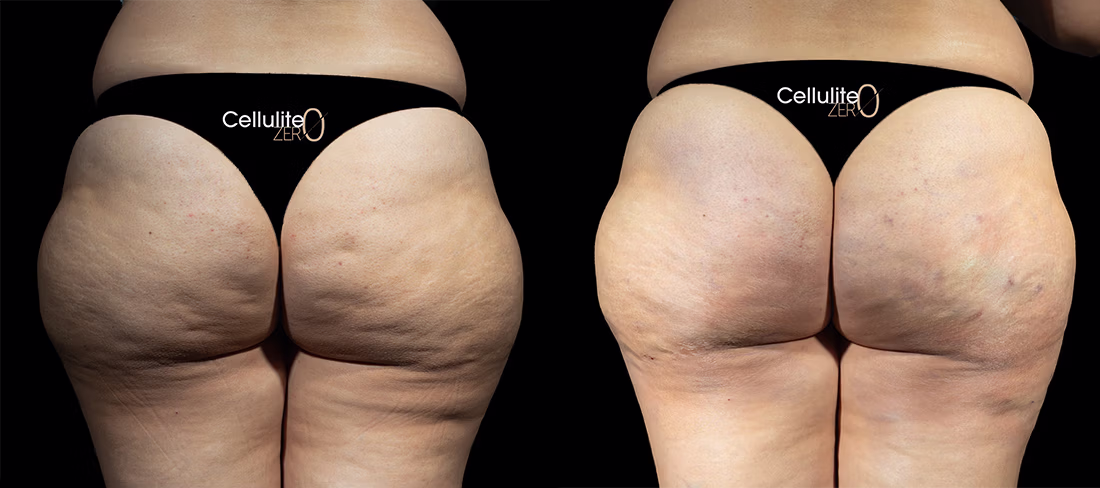 REAL PATIENT RESULTS Cellulite ZERO