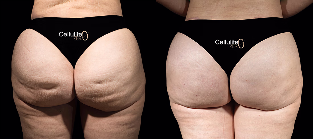 REAL PATIENT RESULTS Cellulite ZERO